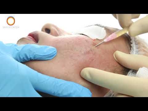 Subcision for Acne Scars | Acne Scar Treatment | Cheek Acne scar removal
