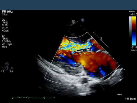 Video: Rozdiel Medzi EKG A Echokardiogramom