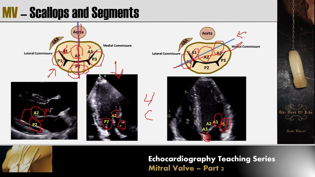 Лекция 12 – Митральный клапан. Часть 2