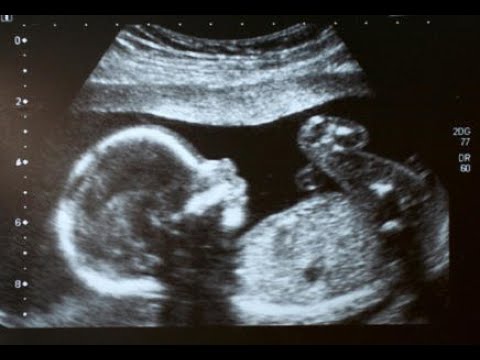 Gender detect when ultrasound can How early