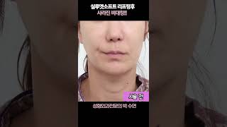 실루엣소프트 리프팅후 사라진 비대칭!! #실리프팅#실루엣소프트#얼굴비대칭#박수연원장