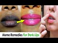 काले होठों को गुलाबी और सूंदर बनाये /Get Baby Soft Pink Lips Naturally होठों का कालापन कैसे दूर करें