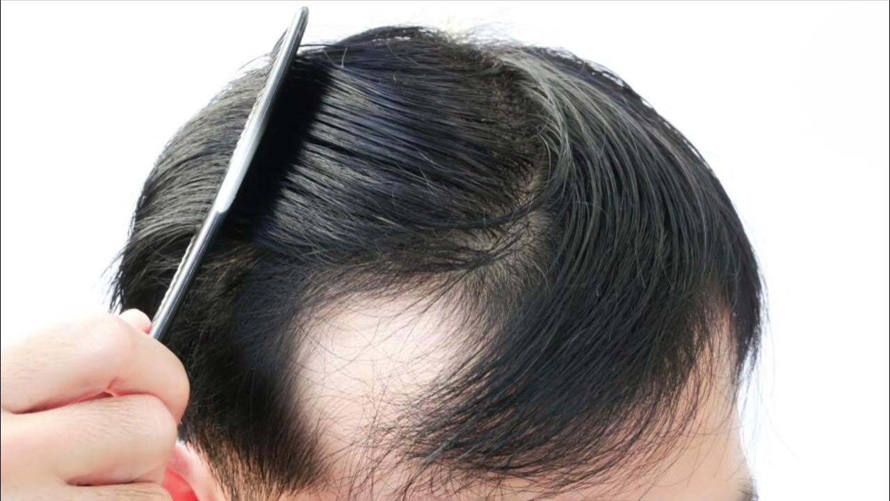 Врач занимающийся волосами. Выпадение волос у мужчин. Hair loss.