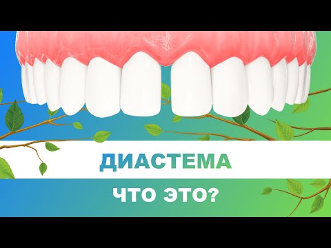 Video: Диастема басымдуубу же рецессивдүүбү?