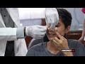 "Extremely Happy with the results" | Rhinoplasty Surgery | Splint Removal