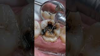 Jaw tooth repair🗿#jaw