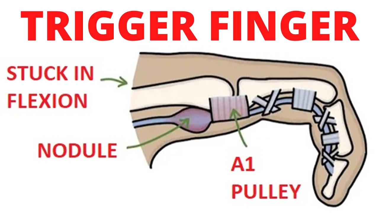 Trigger finger | Everything You Need to Know - YouTube