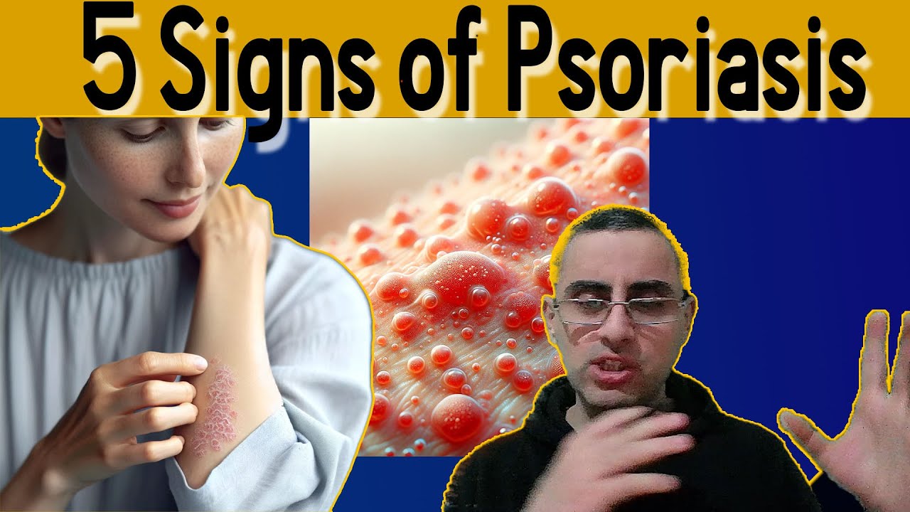 5 Signs of Psoriasis - Psoriasis Treatment (fully Reviewed) - YouTube