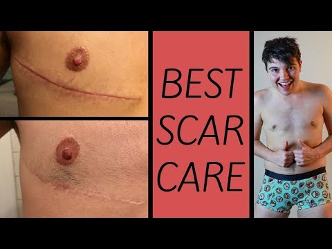 How To Make Your Scars Disappear! (Top Surgery - FTM Transgender)