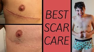 Famous How To Make Your Scars Disappear! (Top Surgery - FTM Transgender) Net Worth