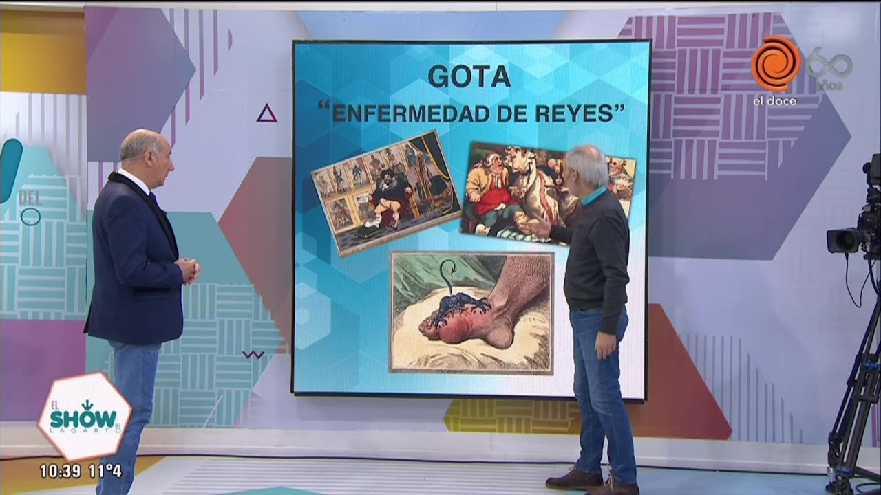Ácido úrico y fructosa - La gota: Enfermedad de reyes - Dr. Carlos