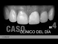 Disilicato de Lítio, un material versátil | #CasoClínicoDelDía | Milko Villarroel