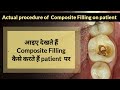 देखिए Composite Filling पेशेंट में कैसे करते हैं? l Composite Filling on patient