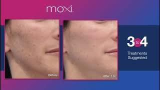 Moxi Skincare Treatment!