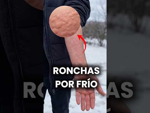 Ronchas que pican después del contacto con el frío y luego desaparecen (Urticaria al frío) #medicina