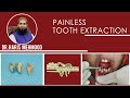 Painless tooth extraction at hassaan dental clinic rawalpindiislamabad 2022