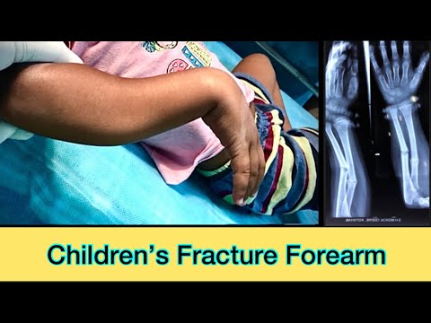 Paediatric Fracture Forearm | Green stick fracture forearm in kids clinical presentation &Management