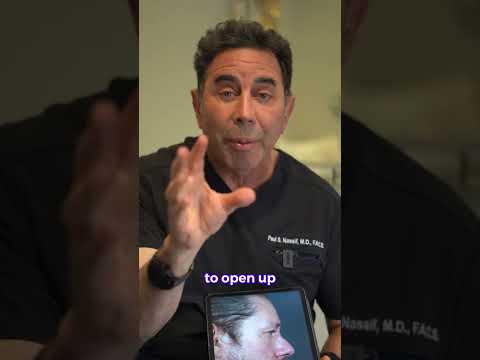 Video thumbnail: Revision Rhinoplasty Before & after | Dr. Nassif · NassifMD®