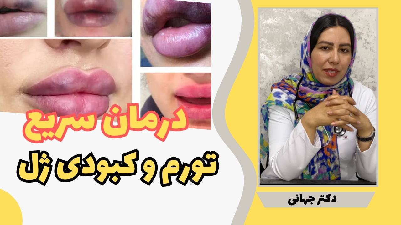 مراقب های مهم در خانه پس از تزریق ژل/این ۷ کار رو نکن - YouTube