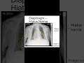 Easy to Miss - Hiatus Hernia on a Chest X-ray (ABCDE)