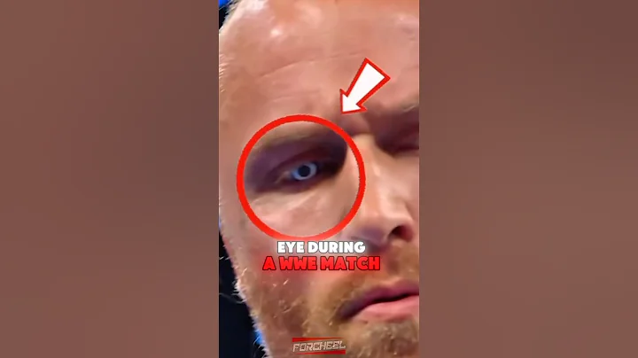 He LOST an EYE during a WWE match! 😱 #WWE #AleisterBlack #SmackDown