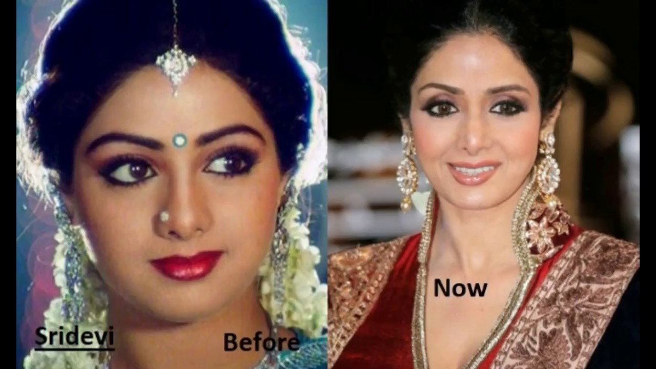 Top 10 Plastic Surgery Photos Of Popular Bollywood Actresses  BEFORE & AFTER