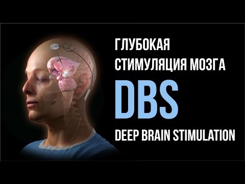 Глубокая стимуляция мозга РНХИ им. проф. А.Л. Поленова / Deep Brain Stimulation (DBS)