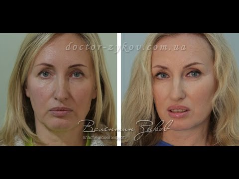 Височный лифтинг фото до и после отзывы