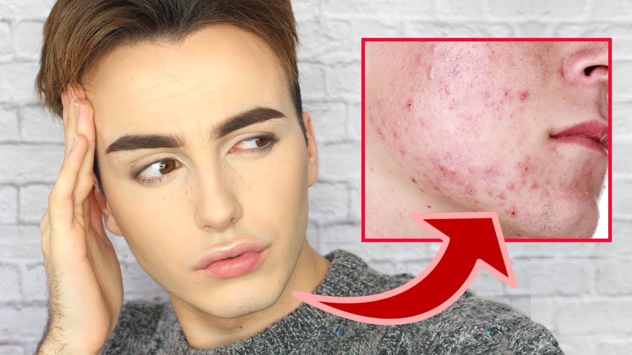 COMMENT NE PLUS AVOIR D'ACNE | Kam HUGH - YouTube