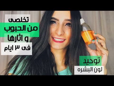 تخلصى من الحبوب واثارها  مع خل التفاح فى 3 ايام- How to use apple cider vinegar on your skin