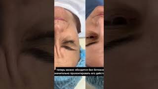 #безинъекций #уходдлялица #безуколов #ботокс #безботокса #процедуры #омоложениелица #морщиныналбу
