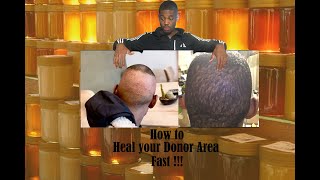 How to heal your donor area fast after a hair transplant |asli tarcan | african american | black