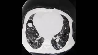 Chest CT : Cannonball metastases to the lungs