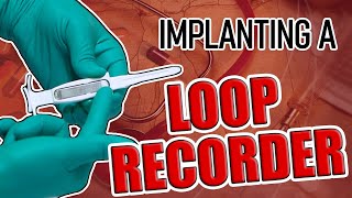 Loop Recorder Implant Procedure by Dr. Pradip Jamnadas, MD 96,084 views 3 years ago 5 minutes, 9 seconds