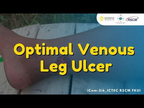Optimal Venous Leg Ulcer Management