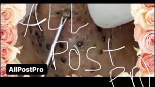 Satisfying blackhead removal