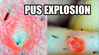 WORST Ingrown Hair of the year!! Popping it with the follicle