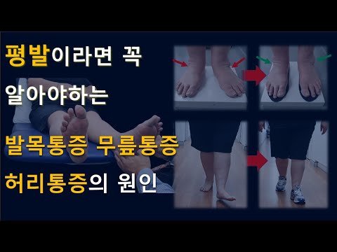 [평발교정 #5] 평발교정깔창으로 발목통증 무릎통증 허리통증 개선 [풋닥터솔루션]