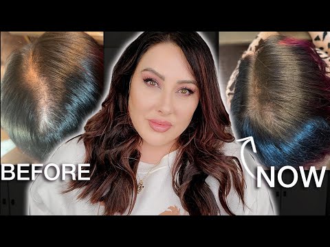 How I Stopped my Hair Loss - MASSIVE Hair Growth Update + Tips for Hair Growth