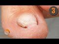 I perform an onychophosis extraction on both big toes and on the 2nd toe of the right foot [Part 3]