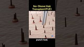 No-Shave Hair Transplant(FUE)