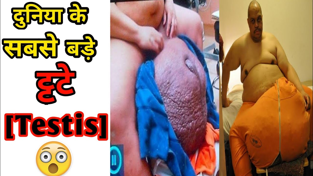 दुनिया के सबसे बड़े टेसटिस 😱 | World's Biggest Testis | World's Biggest