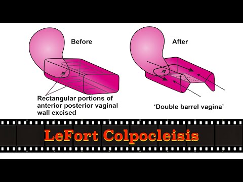 Vidéo: Colpocleisis: Procédure, Récupération, à Quoi S'attendre Et Plus