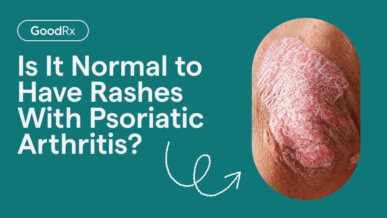 Posiatic Rash Psoriatic Arthritis Rashes: What Do They Look Like? | GoodRx - YouTube