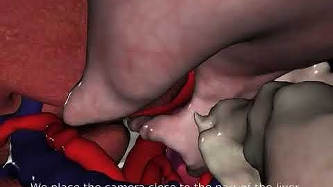 GPU-based Real-Time Soft Tissue Deformation with Cutting and Haptic Feedback