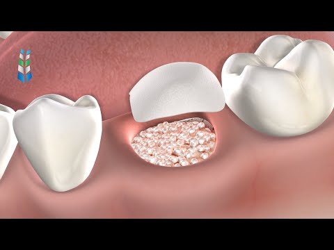 Post-Op Instructions: General/Extractions in Springfield IL | Oral & Facial Surgeons of Illinois