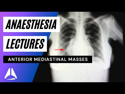 Anterior mediastinal mass and Anaesthesia - traps and myths