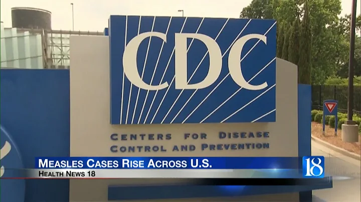 Health News 18: Measles cases on the rise