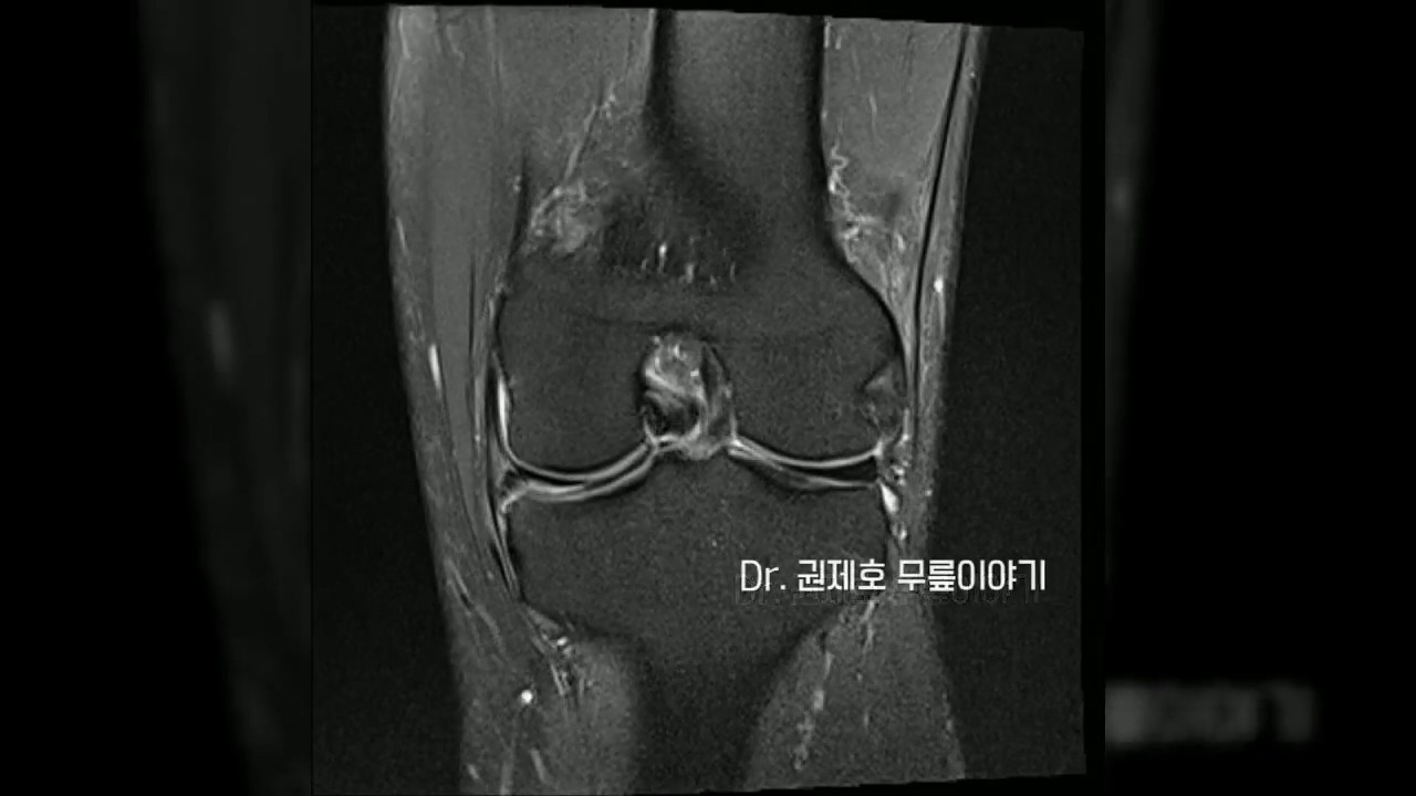 반월상연골판파열 무릎관절경 부분절제술 과정 Arthroscopic Meniscectomy Procedure
