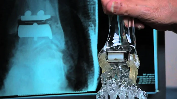 Roger Mann, MD details the STAR ankle